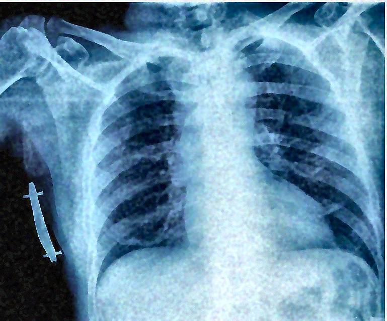 Hasil Akhir Restorasi Citra Rontgen Thorax