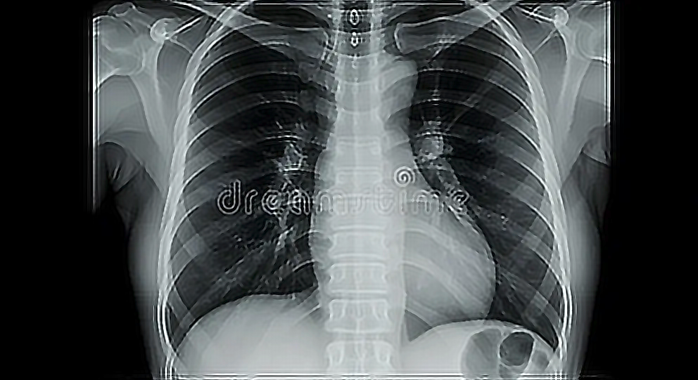 Hasil Akhir Restorasi Citra Rontgen Thorax